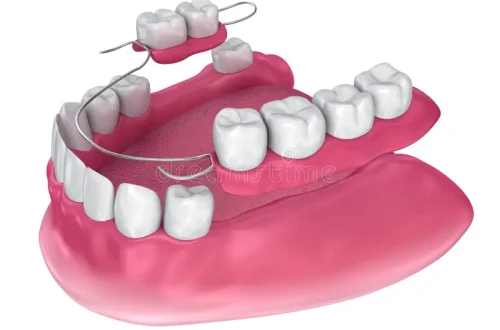 протез-частично-removable-с-медицинской-точки-зрения-точный-точной-167616400 протез-частично-removable-с-медицинской-точки-зрения-точный-точной-167616400